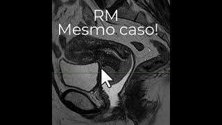 Diferença entre a TC e a RM no estadiamento local do câncer de colo uterino [upl. by Emmi]