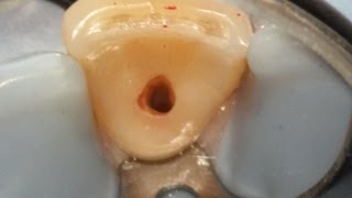 Internal resorption treatment with narration [upl. by Hopfinger]