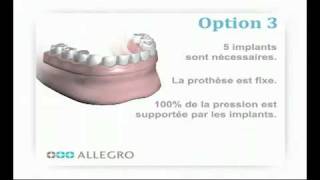 Implants dentaires  Prothèse fixe [upl. by Ellener]