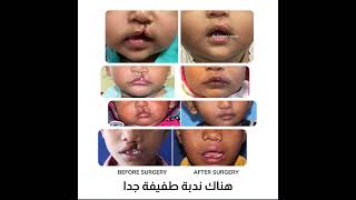 Cleft Lip Repair  Dr Dr Gagan Sabharwal  FUH in a Minute [upl. by Fesuy]