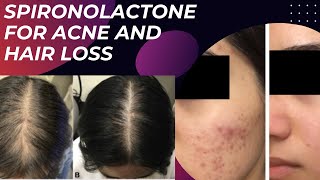 Spironolactone for acne and hair loss  dermatologist explains [upl. by Rimidalg494]