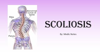 Ortho Scoliosis  postural amp structural Cobbs angle Rissers sign treatment [upl. by Innaig848]