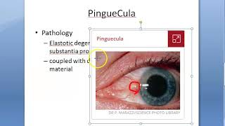 Ophthalmology 095 a PinGueCula What is Eye growth Yellow Degenerative Conjunctiva Reason Etiology [upl. by Gradeigh354]