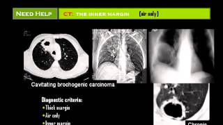 Chest X ray  Dr Mamdouh Mahfouz [upl. by Felicia]