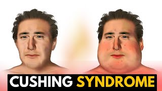 Cushing Syndrome Causes Signs and Symptoms Diagnosis and Treatment [upl. by Ardnwahs]