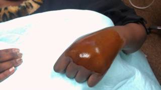 hand hematoma drainage [upl. by Reid]