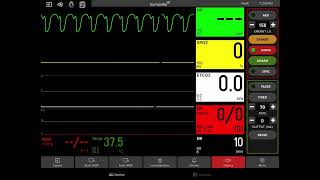 Pulseless Ventricular Tachycardia with Defibrillation [upl. by Ayiak124]