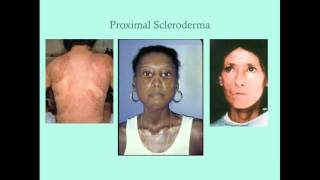 Scleroderma  CRASH Medical Review Series [upl. by Dymphia]