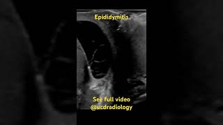 Epididymitis radiologist radiology ultrasound medicine medicalschool [upl. by Bina685]