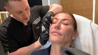 Sculptra  CollagenStimulating Injections  West Hollywood CA  Dr Jason Emer [upl. by Shiau]