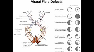 Lesions in the lower optic radiations and superior quadrantanopia [upl. by Doscher77]