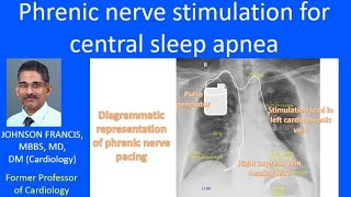 Phrenic nerve stimulation for central sleep apnea [upl. by Bronk385]