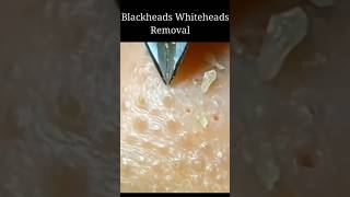 Whitehead Removal At Home blackheadswhiteheads skincare whiteheads song [upl. by Tanya]