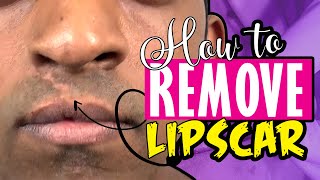 How to remove lip scar improve shape and make in more luscious  permanent facial plasticsurgery [upl. by Dela]