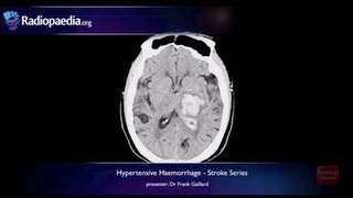 Stroke Hypertensive haemorrhage  radiology video tutorial MRI CT [upl. by Oilerua]