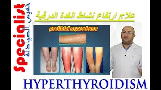 15 Hyperthyroidism ارتفاع نشاط الغدة الدرقية  الادوية المساعدة  اندرال اقراص  خميس الصيادلة [upl. by Reamy989]