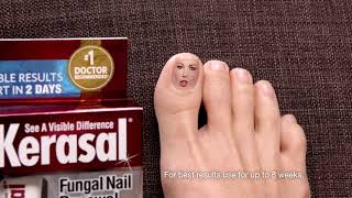 Kerasal® Fungal Nail Renewal™ Improves Appearance of Discolored or Damaged Nails [upl. by Gally]