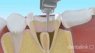 Endodoncia completa PASO A PASO  Video 3D [upl. by Burkley]