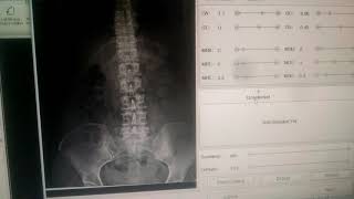 Digital X Ray lumber spine ap lateral view with thoracic spine edit Fcr software CR Fuji flim [upl. by Airda]