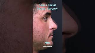 Mens Facial Plastic Surgery [upl. by Odicalp]