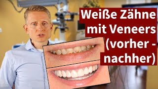 Weiße Zähne mit Veneers vorher  nachher 2021 [upl. by Yance237]