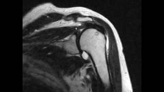 supraspinatus tendon tear [upl. by Akienat]