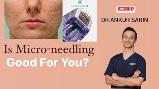 Facts about micro needling  Acne Scar Treatment  Dermapen 4  Morpheus 8 Dermaroller Dr Ankur [upl. by Yadahs218]