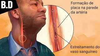 ATEROSCLEROSE – Sintomas Prevenção e Tratamento  Biologia com Patrick Gomes [upl. by Leynad]