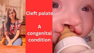 Cleft palate A congenital condition [upl. by Raveaux938]