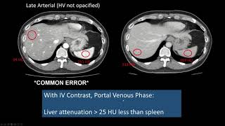 Interpreting CT Abdo Background Liver Hepatic Steatosis High Attenuation Liver [upl. by Batty]