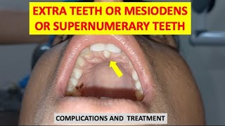 SUPERNUMERARY TEETH MESIODENS EXTRA TEETH COMPLICATIONS AND TREATMENT dentalcafe4331 [upl. by Anitsahs804]