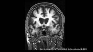 Huntingtons Disease [upl. by Rafferty]