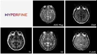 Middle Cerebral Artery Watershed Stroke [upl. by Lupien]