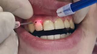 Laser Gingivectomy gum cutting using laser gingival line reshaping after braces removal [upl. by Franci639]