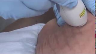 Stretch Marks with Palomar Fractional Laser [upl. by Ailhat]