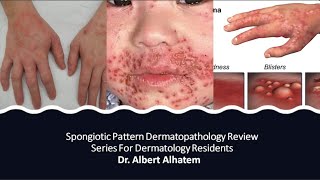 Dermatopathology Lesson 1 Spongiotic Dermatitis Tissue Reaction Patterns [upl. by Tychon]