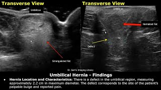 Hernia Ultrasound Reporting  DirectIndirect InguinalEpigastricFemoral Hernia USG Reports [upl. by Winton766]