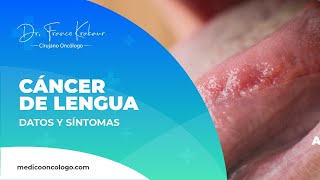 Cáncer de Lengua  Datos y Síntomas  Dr Franco Krakaur Cirujano Oncólogo [upl. by Innavoig823]