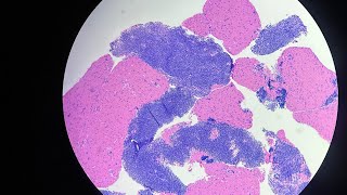 Mediastinal Thymoma with Lung Invasion Diagnosed by EBUSPLBPeribronchialSmall Biopsy25th Video [upl. by Anstice]