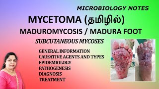 Mycetoma  Maduromycosis  Madura Foot  Subcutaneous mycoses  Dr Blessy  Tamil  Microbiology [upl. by Naujuj155]