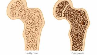 Difference Between Osteoporosis and Osteomalacia [upl. by Delwin]