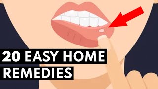 How To Get Rid Of Canker Sores FAST [upl. by Krysta287]