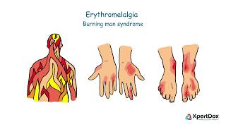 What is Erythromelalgia [upl. by Nyrehtac]