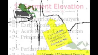 Teaching 12 Lead EKG STEMI or early repol [upl. by Zeta]