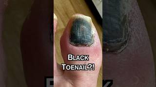 Why is my TOENAIL BLACK 😳 [upl. by Marquis]