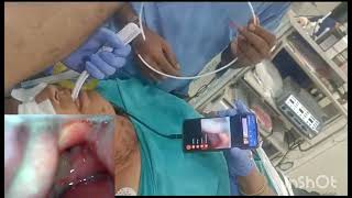 Ludwigs Angina High Risk Intubation done using Tascope [upl. by Inan]