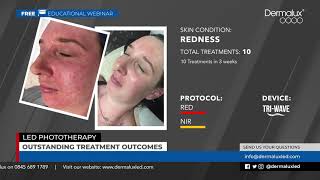 Dermalux Educational Webinar  Outstanding Treatment Outcomes [upl. by Julianna676]