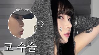 코 수술 vlog👃🏻  수술 당일2달차 회복 과정 • 코 재수술 • 자가늑 후기 [upl. by Ecenahs581]