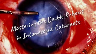 How to Master the Double Rhexis Technique for intumescent cataract  a video guide [upl. by Einnaffit]