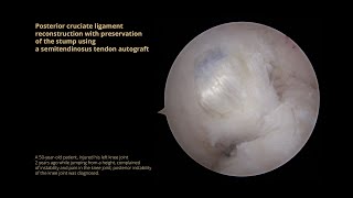 Posterior cruciate ligament reconstruction with preservation of the stump using a semitendinosus ten [upl. by Lacefield]